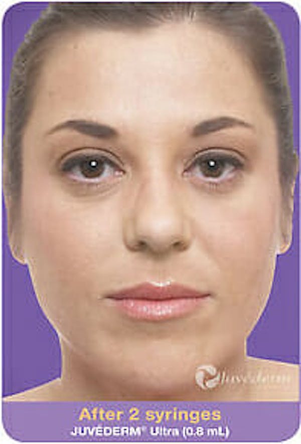 Juvederm Before & After Gallery - Patient 9605818 - Image 2