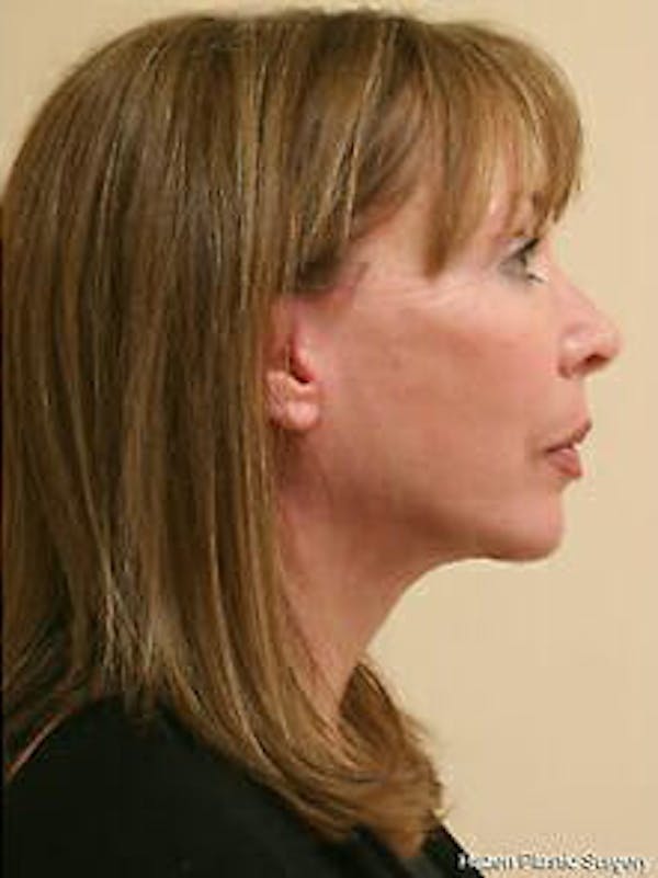 Facelift Before & After Gallery - Patient 9605823 - Image 5