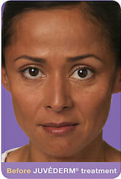Juvederm Before & After Gallery - Patient 9605824 - Image 1