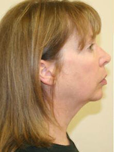 Facelift Before & After Gallery - Patient 9605823 - Image 6