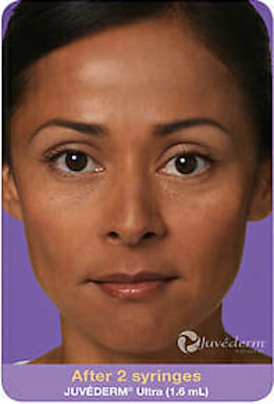 Juvederm Before & After Gallery - Patient 9605824 - Image 2