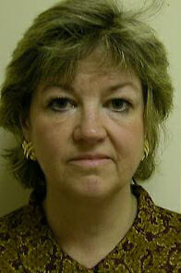 Facelift Before & After Gallery - Patient 9605826 - Image 1