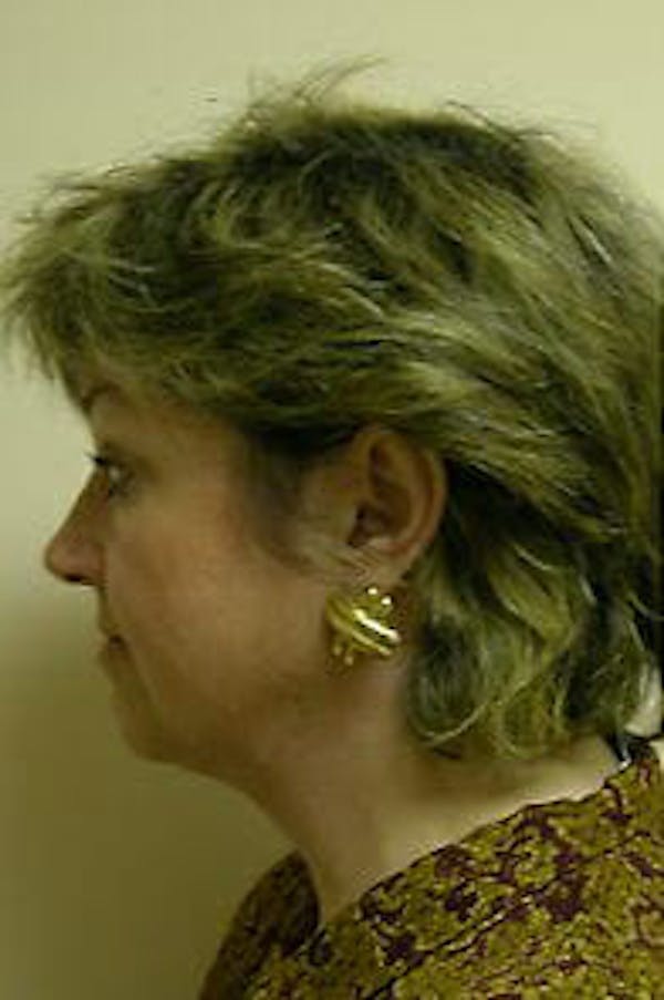 Facelift Before & After Gallery - Patient 9605826 - Image 5