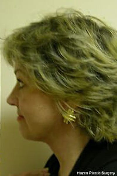Facelift Before & After Gallery - Patient 9605826 - Image 6