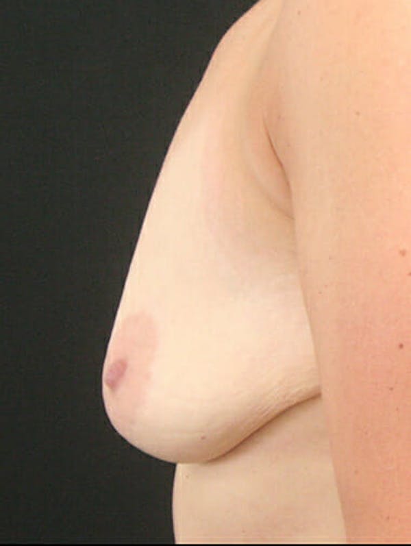 Mastopexy Before & After Gallery - Patient 9605827 - Image 5