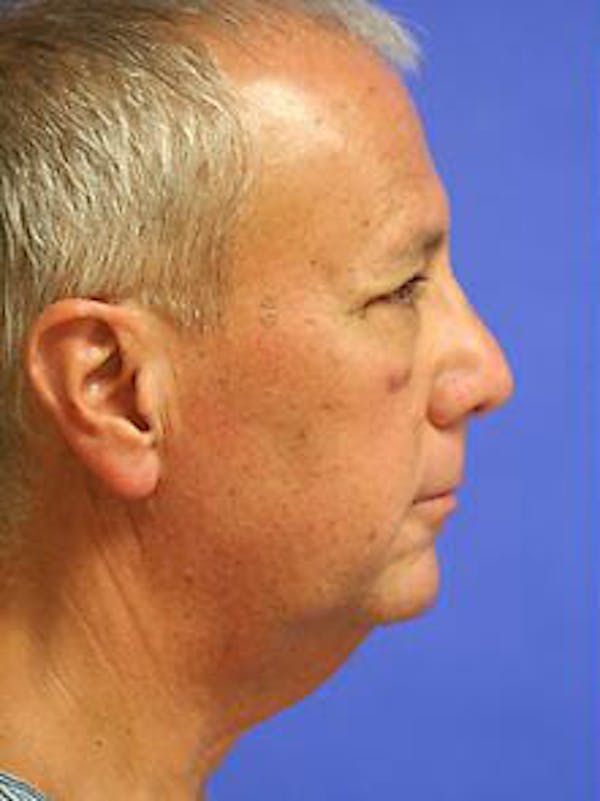 Facelift Before & After Gallery - Patient 9605830 - Image 5