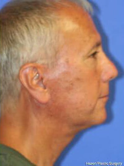 Facelift Before & After Gallery - Patient 9605830 - Image 6
