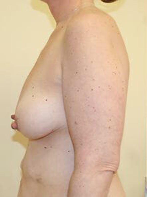 Mastopexy Before & After Gallery - Patient 9605831 - Image 5