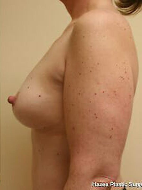 Mastopexy Before & After Gallery - Patient 9605831 - Image 6