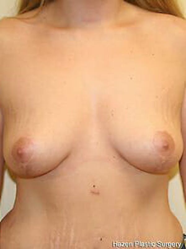 Mastopexy Before & After Gallery - Patient 9605836 - Image 2