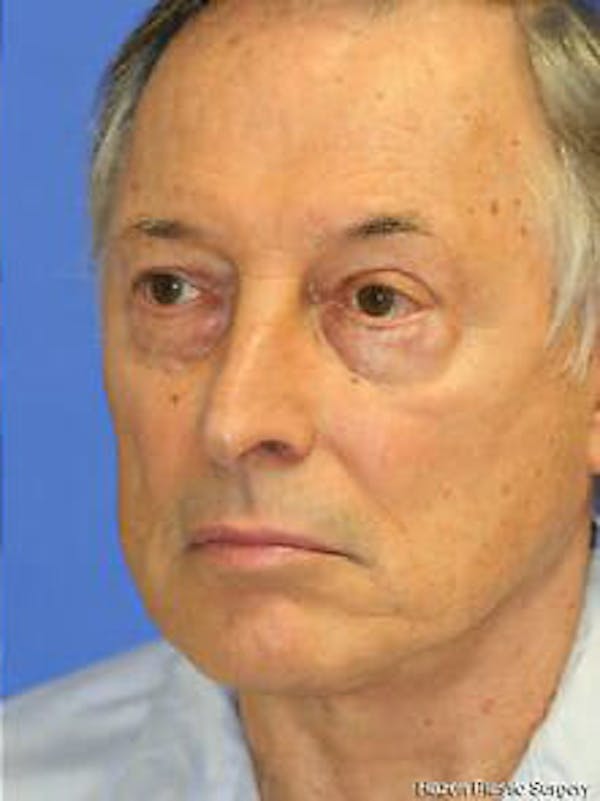 Facelift Before & After Gallery - Patient 9605834 - Image 4