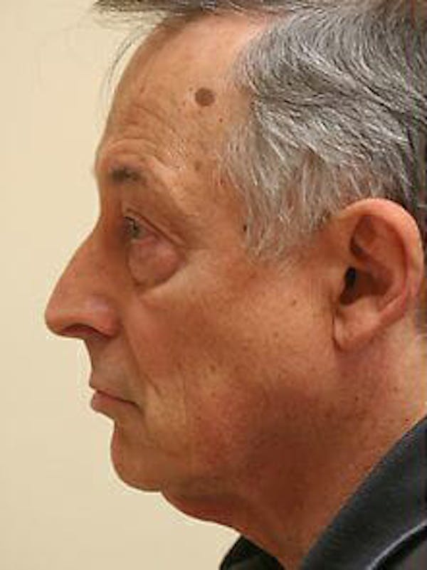 Facelift Before & After Gallery - Patient 9605834 - Image 5