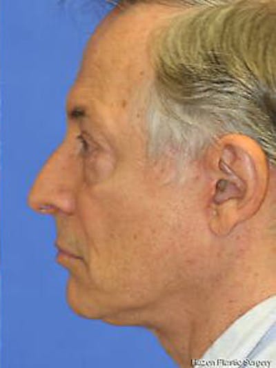 Facelift Before & After Gallery - Patient 9605834 - Image 6