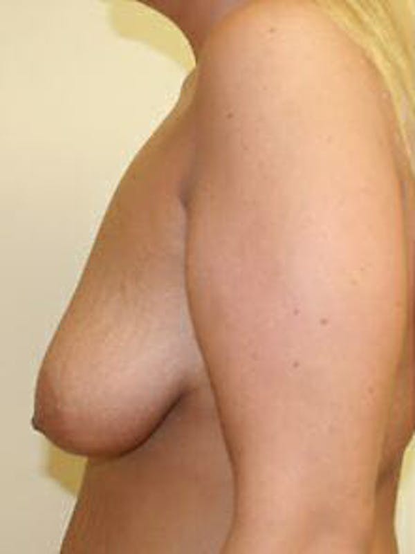 Mastopexy Before & After Gallery - Patient 9605836 - Image 5