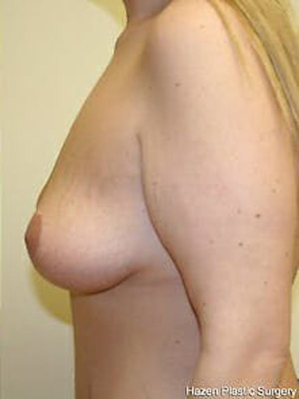 Mastopexy Before & After Gallery - Patient 9605836 - Image 6