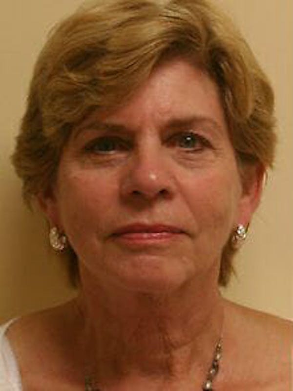 Facelift Before & After Gallery - Patient 9605838 - Image 1