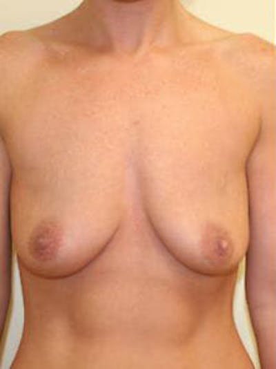 Mastopexy Before & After Gallery - Patient 9605839 - Image 1