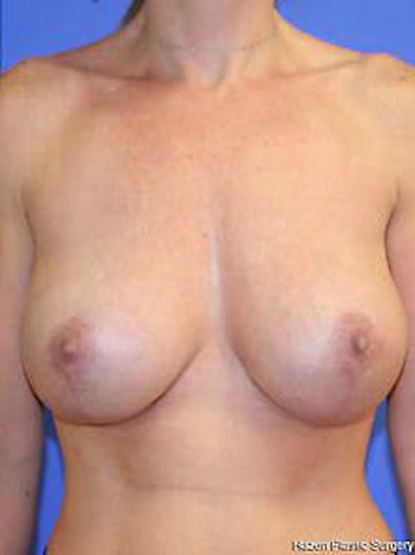 Mastopexy Before & After Gallery - Patient 9605839 - Image 2