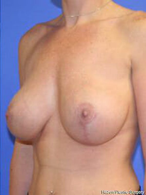Mastopexy Before & After Gallery - Patient 9605839 - Image 4