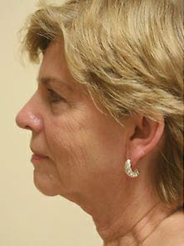 Facelift Before & After Gallery - Patient 9605838 - Image 5