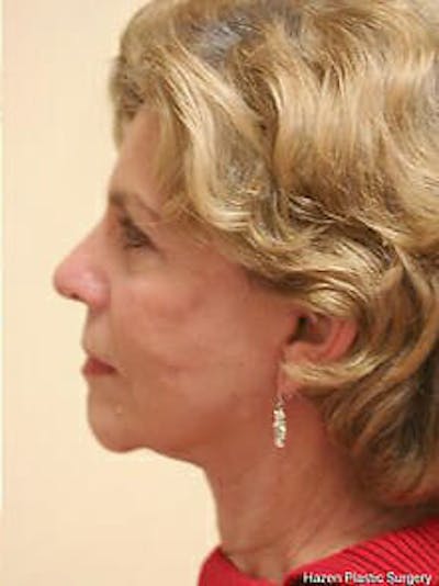 Facelift Before & After Gallery - Patient 9605838 - Image 6