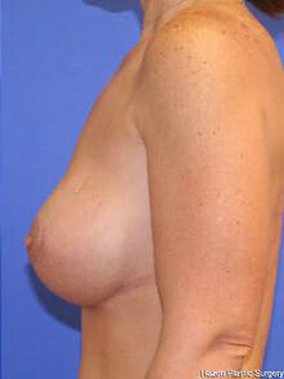 Mastopexy Before & After Gallery - Patient 9605839 - Image 6