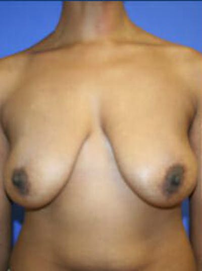 Mastopexy Before & After Gallery - Patient 9605844 - Image 1
