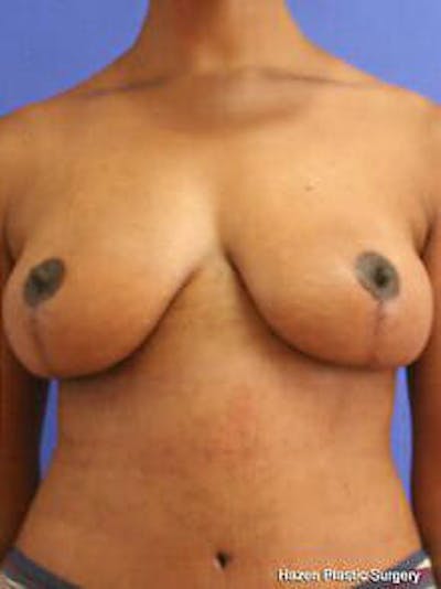 Mastopexy Before & After Gallery - Patient 9605844 - Image 2