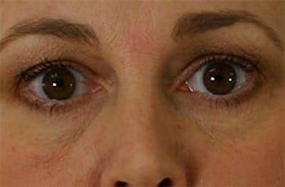 Eye Lift Before & After Gallery - Patient 9605847 - Image 1