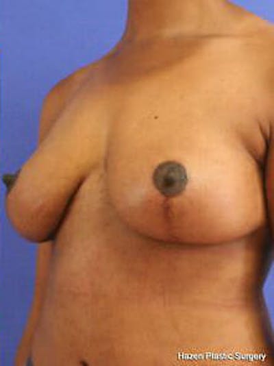 Mastopexy Before & After Gallery - Patient 9605844 - Image 4