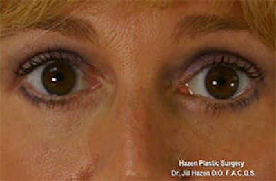 Eye Lift Before & After Gallery - Patient 9605847 - Image 2