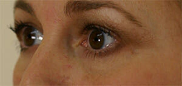 Eye Lift Before & After Gallery - Patient 9605847 - Image 3