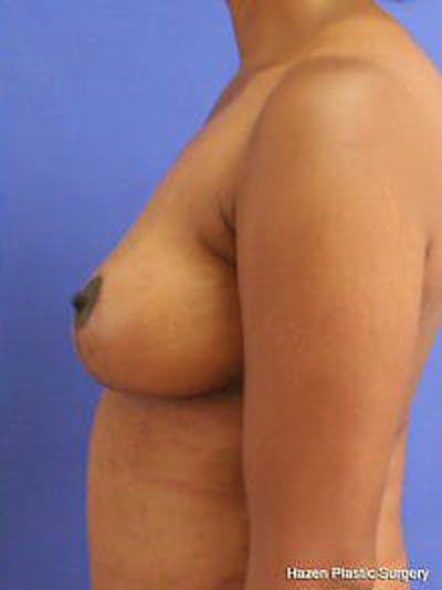 Mastopexy Before & After Gallery - Patient 9605844 - Image 6