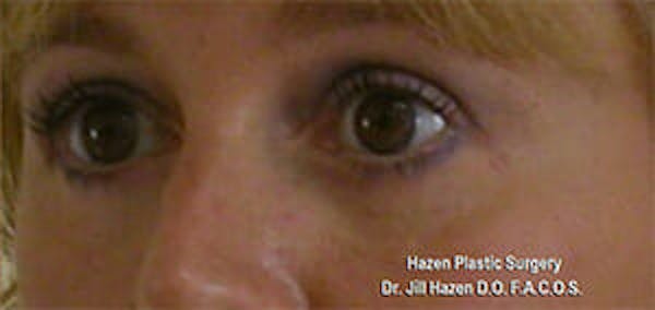 Eye Lift Before & After Gallery - Patient 9605847 - Image 4