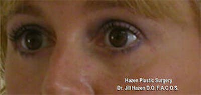 Eye Lift Before & After Gallery - Patient 9605847 - Image 4