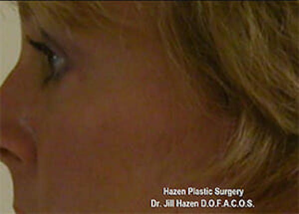 Eye Lift Before & After Gallery - Patient 9605847 - Image 6