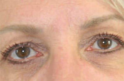 Eye Lift Before & After Gallery - Patient 9605848 - Image 1