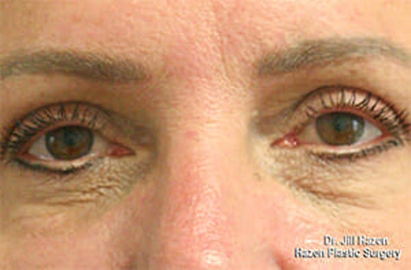 Eye Lift Gallery - Patient 9605848 - Image 2