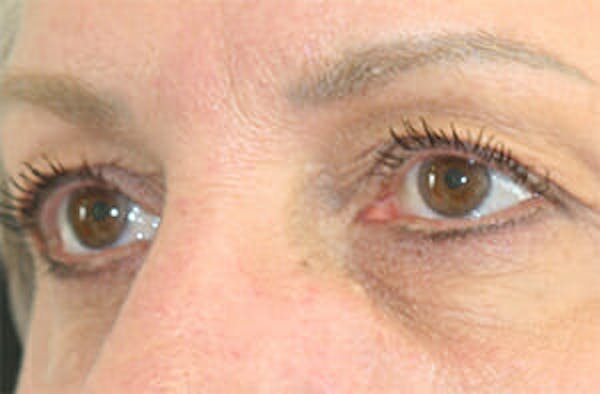 Eye Lift Before & After Gallery - Patient 9605848 - Image 3