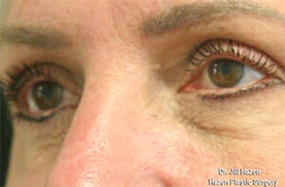 Eye Lift Before & After Gallery - Patient 9605848 - Image 4