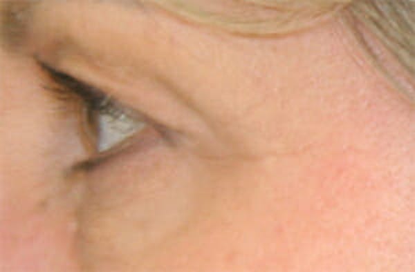 Eye Lift Before & After Gallery - Patient 9605848 - Image 5