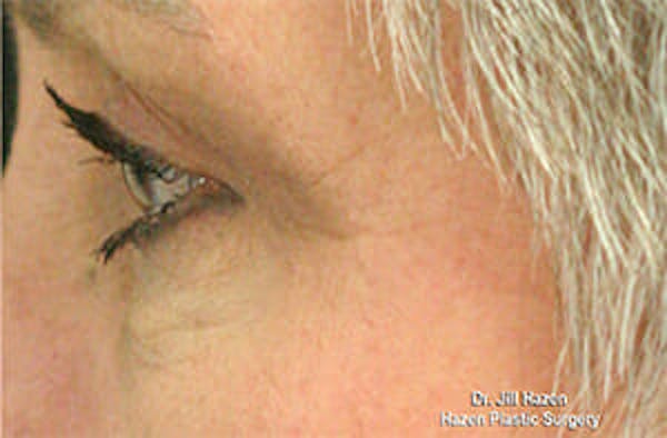 Eye Lift Before & After Gallery - Patient 9605848 - Image 6