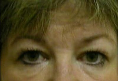 Eye Lift Before & After Gallery - Patient 9605853 - Image 1