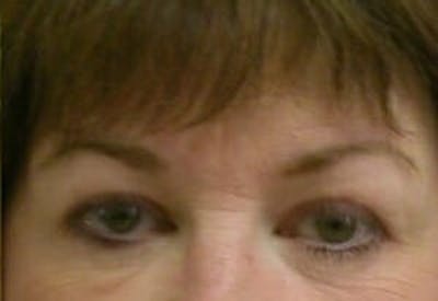 Eye Lift Before & After Gallery - Patient 9605853 - Image 2