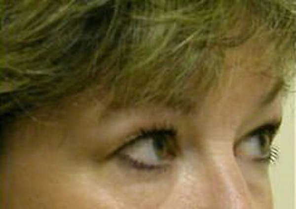 Eye Lift Before & After Gallery - Patient 9605853 - Image 3