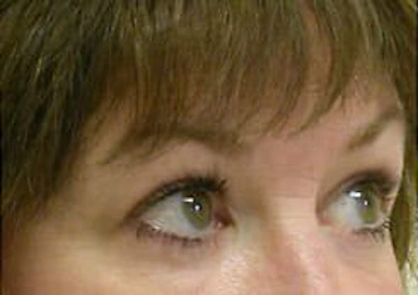 Eye Lift Before & After Gallery - Patient 9605853 - Image 4
