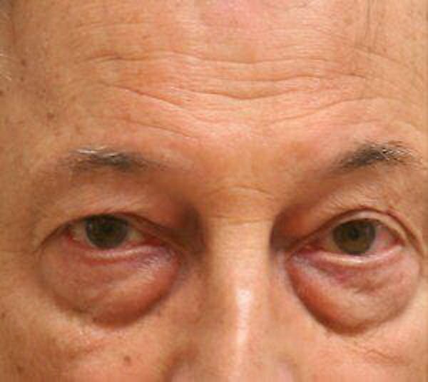 Eye Lift Before & After Gallery - Patient 9605854 - Image 1