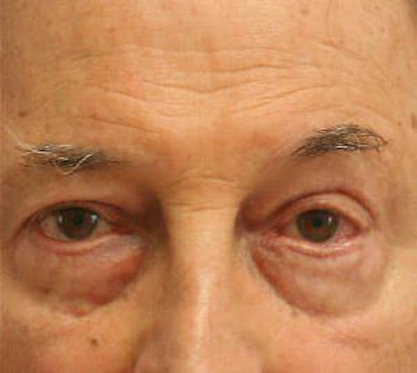 Eye Lift Before & After Gallery - Patient 9605854 - Image 2