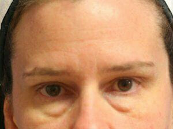 Eye Lift Before & After Gallery - Patient 9605855 - Image 1