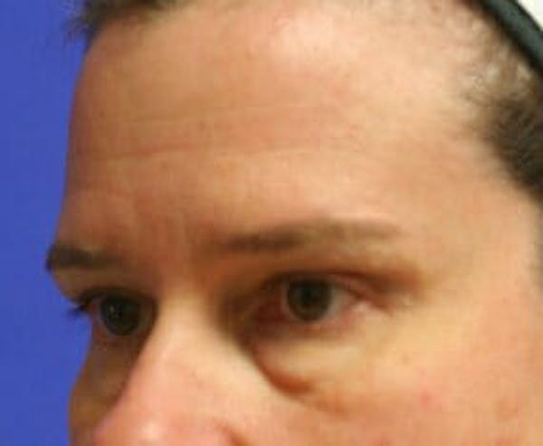 Eye Lift Before & After Gallery - Patient 9605855 - Image 3